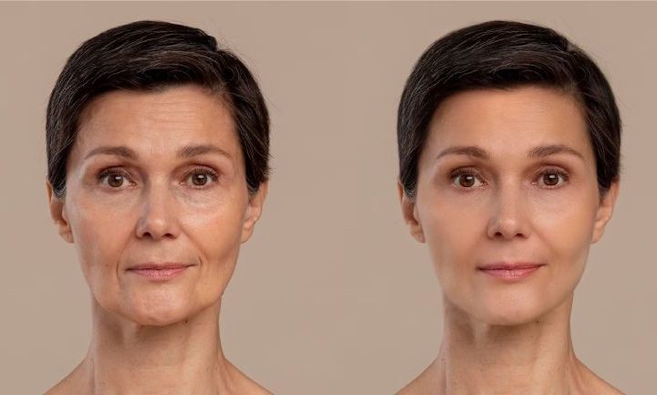 Revitalize Your Appearance with a SMAS Lift Procedure