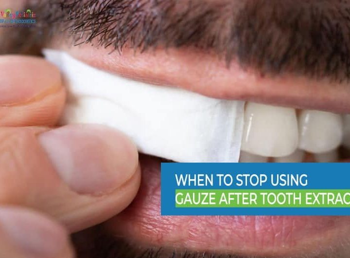 Guideline: How Long Should I Use Gauze After Tooth Extraction