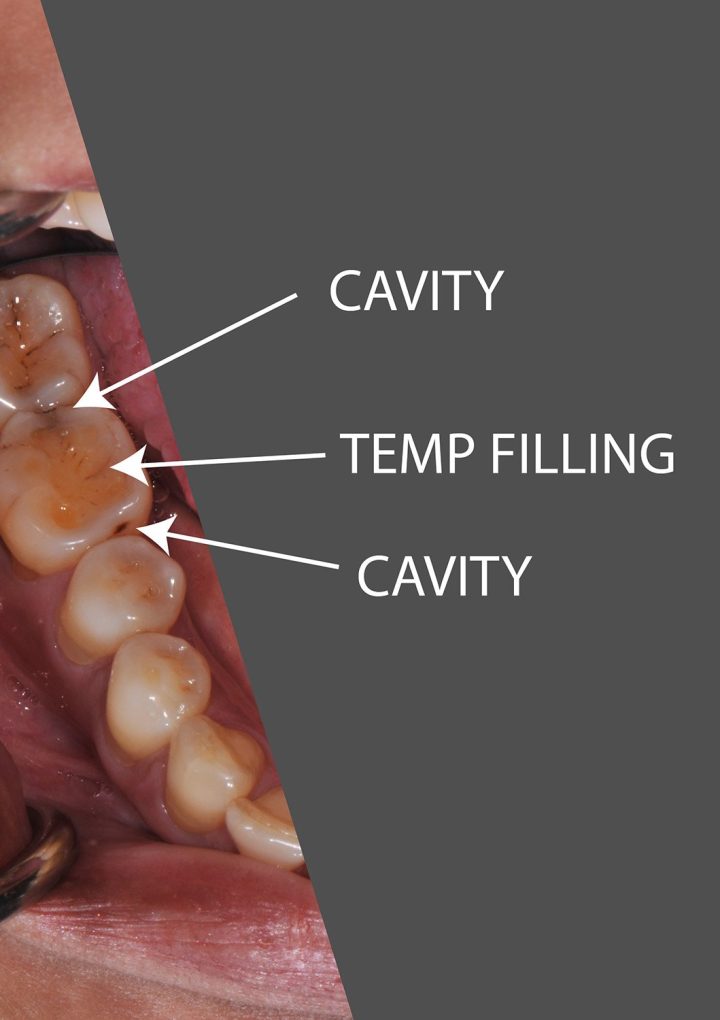 When To Get Permanent Filling After Root Canal