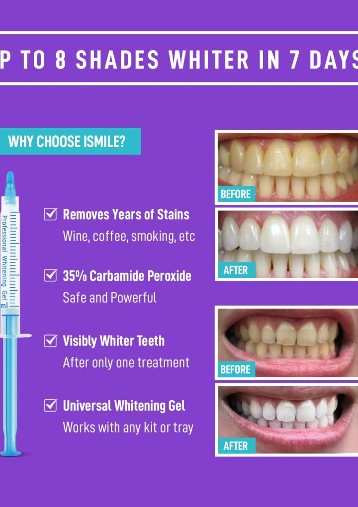 How Often Should You Whiten Your Teeth With Gel: Expert Advice